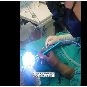 LASER ΚΟΓΧΟΠΛΑΣΤΙΚΗ